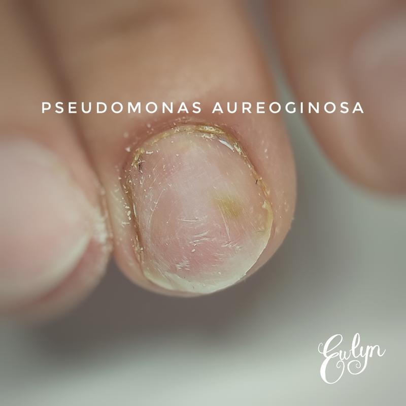 Leczenie infekcji paznokci