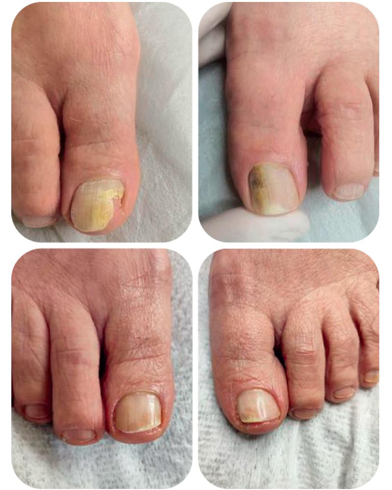 Regeneracja paznokci po hybrydzie