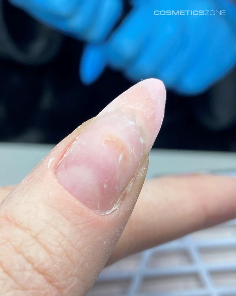 Zielona bakteria na paznokciu