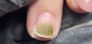 Zielona bakteria na paznokciu – jak ją leczyć i czy naprawdę zaraża?