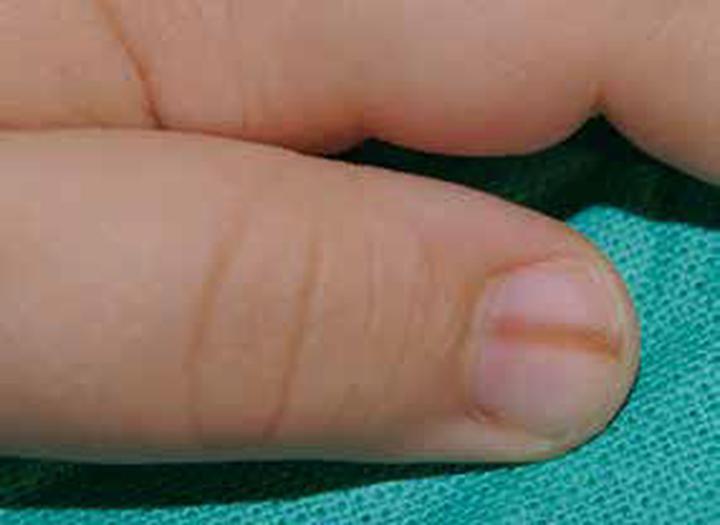 Domowe sposoby na czarne linie