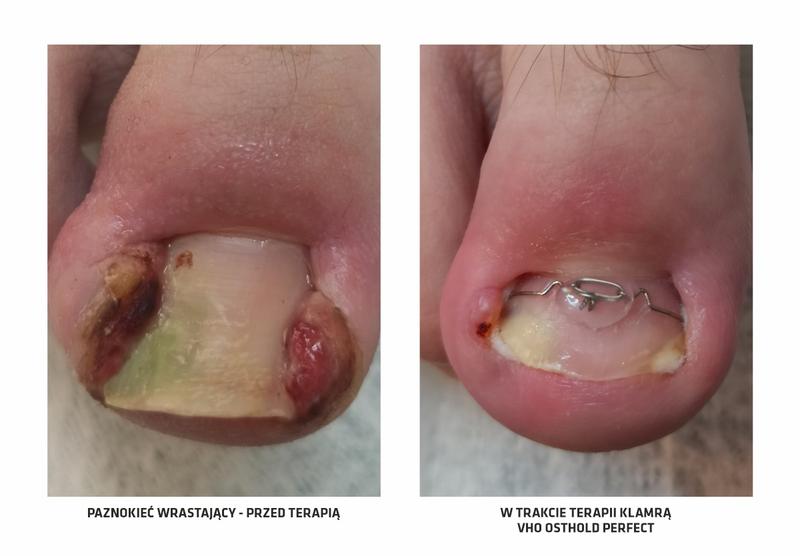 Kiedy udać się do podologa