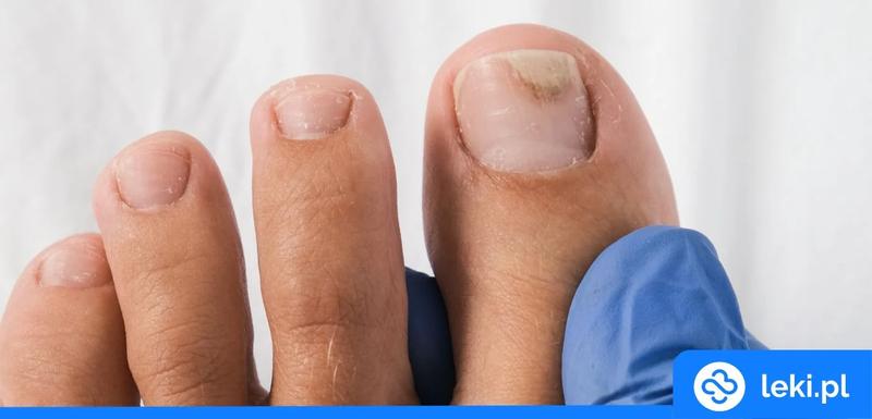 Onycholiza a lakiery hybrydowe