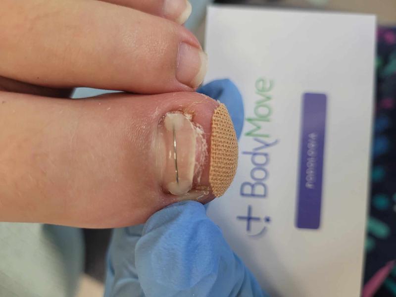 Wrastający paznokieć domowe sposoby