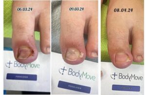 Jak skutecznie zadbać o wrastający paznokieć: bezpieczne domowe sposoby i praktyczne porady