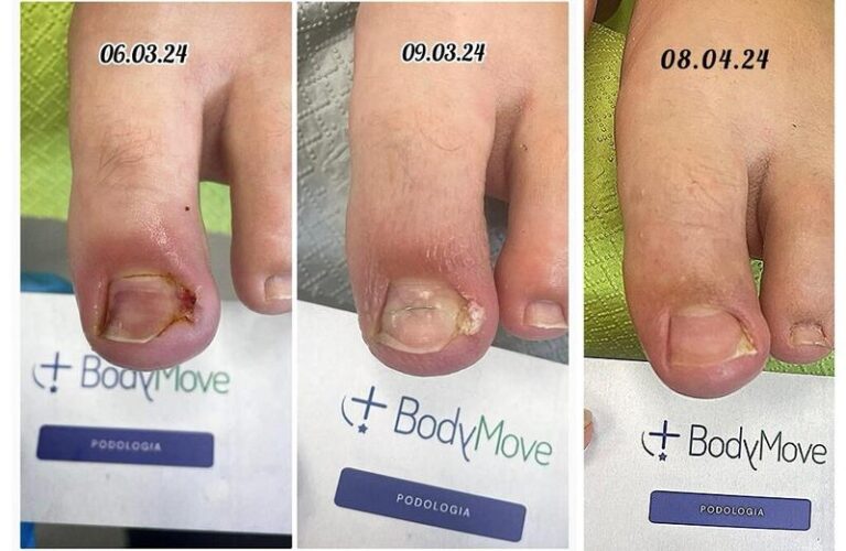 Jak skutecznie zadbać o wrastający paznokieć: bezpieczne domowe sposoby i praktyczne porady