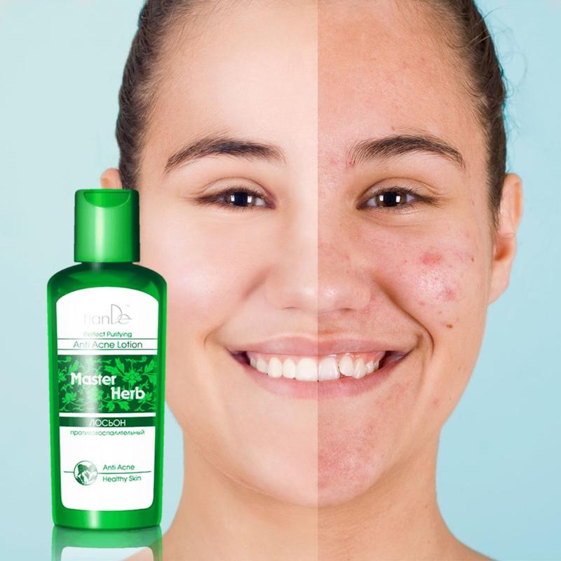 Toniki do cery trądzikowej