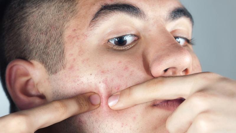 Ukrycie pryszczy bez makijażu