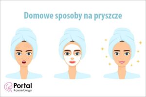 Naturalne sposoby na ukrycie pryszczy bez makijażu – sprawdź, jak to zrobić!