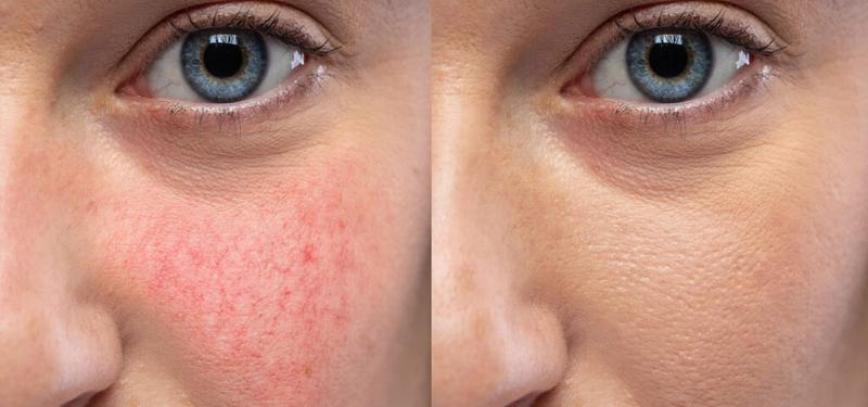 Domowe sposoby na cerę naczynkową