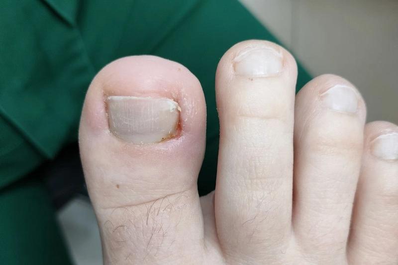 Maści na wrastający paznokieć