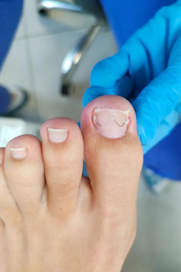 Profilaktyka wrastujących paznokci