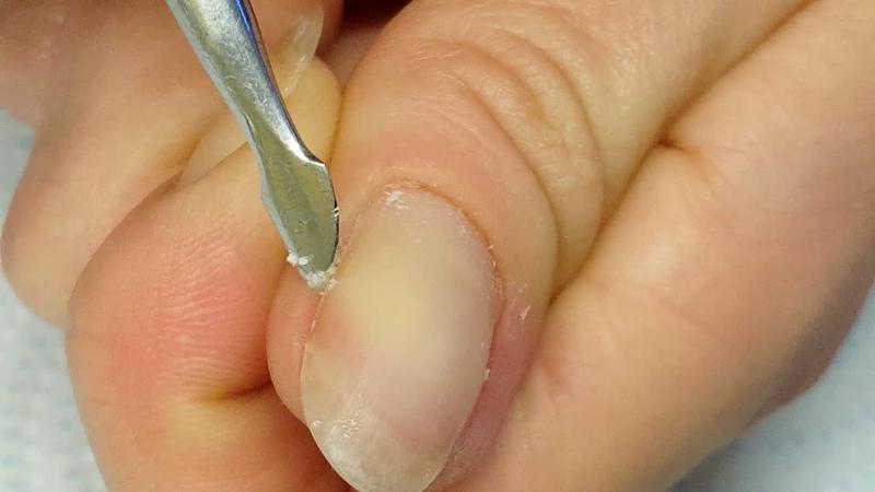 Techniki usuwania skórek krok po kroku