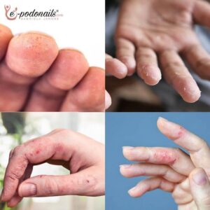 Uczulenie na hybrydę – jak skutecznie rozpoznać objawy i podjąć działania?